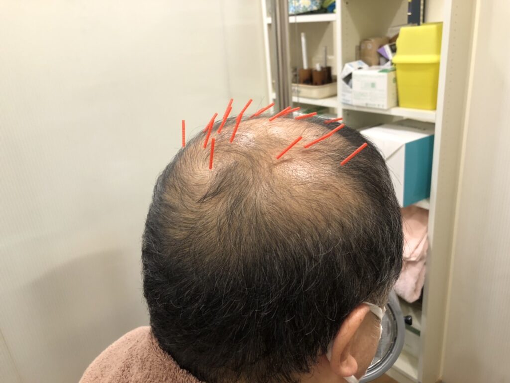 脱毛症対策鍼灸